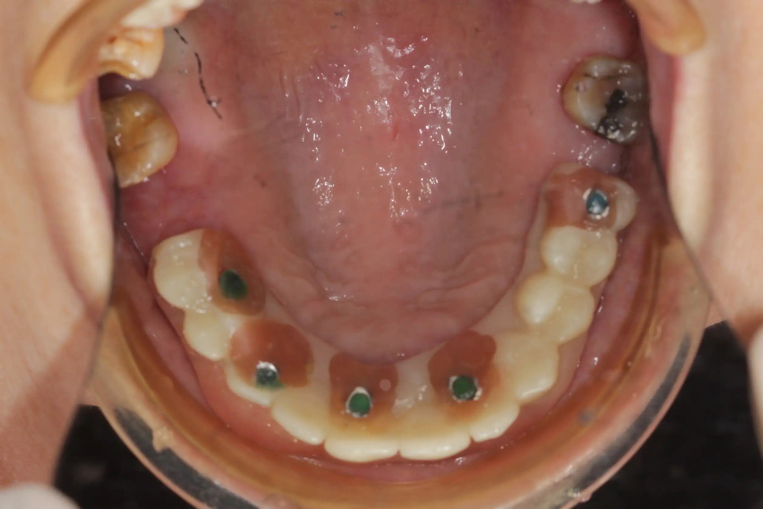 漾潔牙醫診所:全口重建 全口植牙案例
