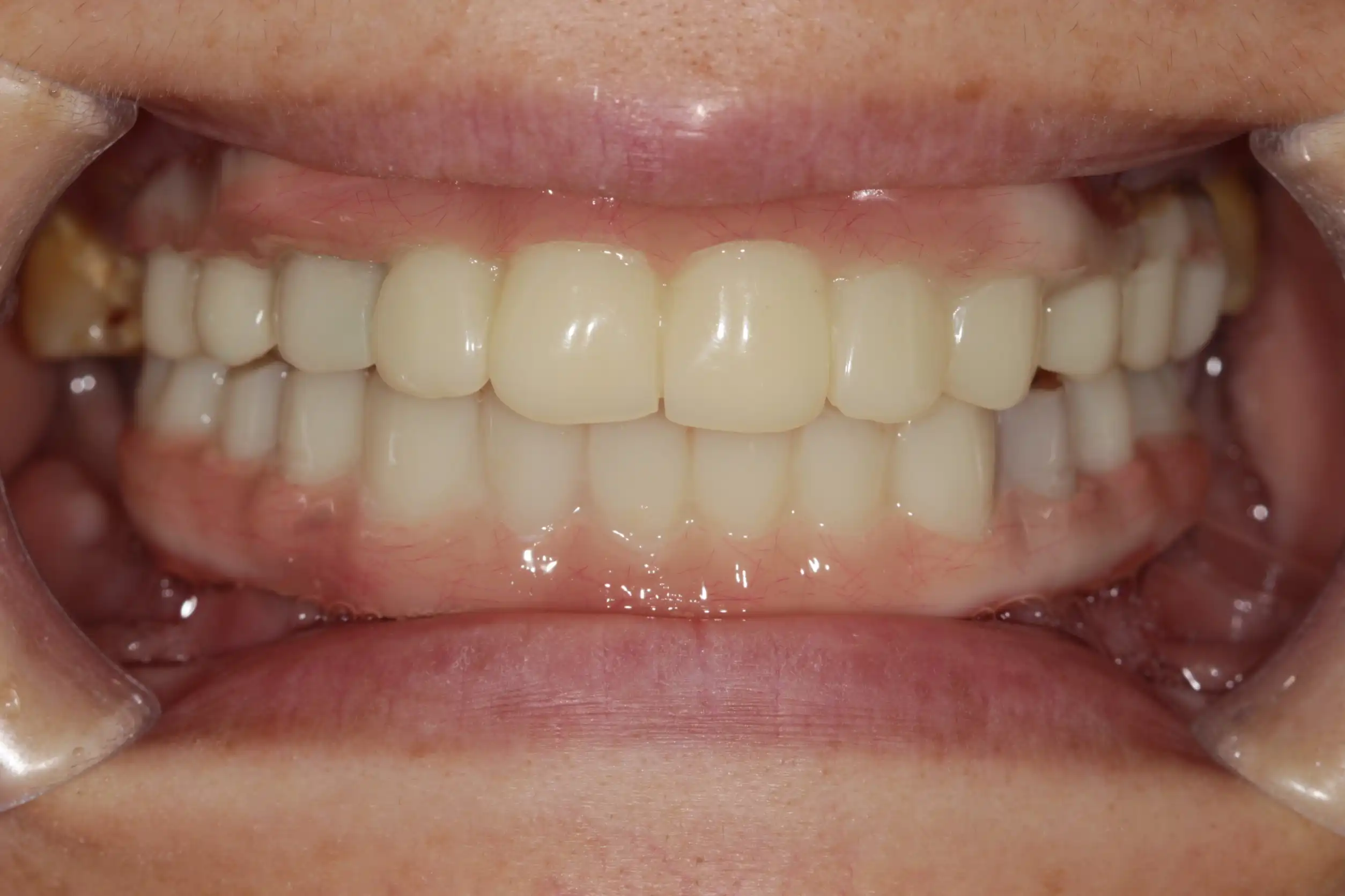 漾潔牙醫診所:全口重建 全口植牙案例