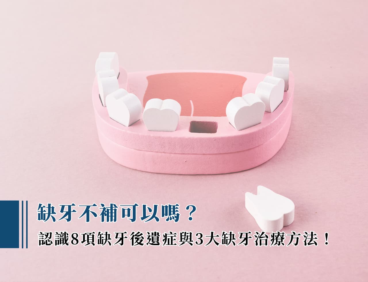 缺牙不補可以嗎？認識 8 項缺牙後遺症與 3 大缺牙治療方法！