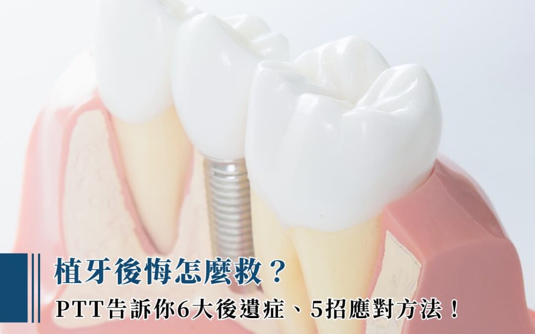 植牙後悔怎麼救? ptt 告訴你 6 大後遺症、 5 招應對方法!