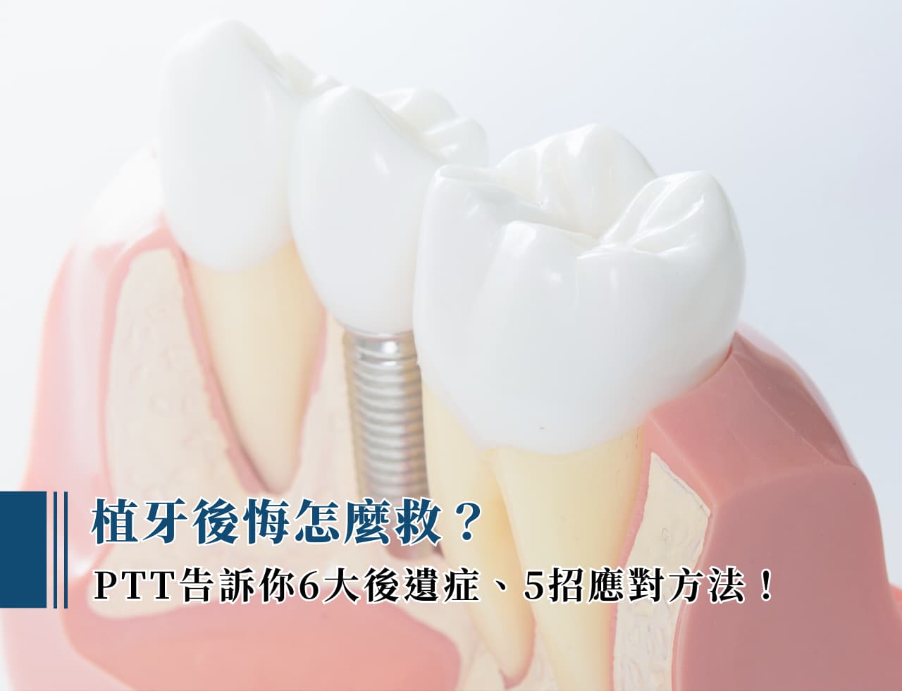 植牙後悔怎麼救？ ptt 告訴你 6 大後遺症、 5 招應對方法！