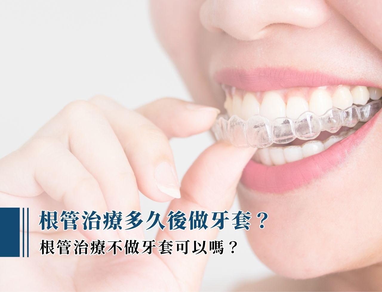根管治療多久後做牙套？根管治療不做牙套可以嗎？