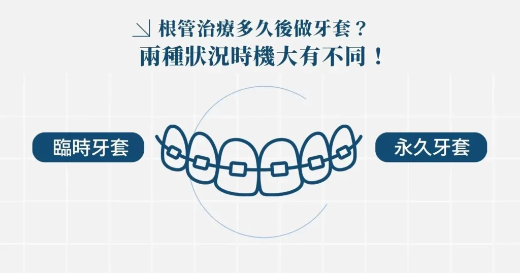 根管治療多久後做牙套?根管治療不做牙套可以嗎? 1 根管治療多久後做牙套?兩種狀況時機大有不同!