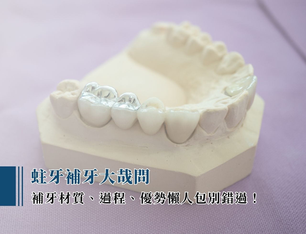 蛀牙補牙大哉問：補牙材質、過程、優勢懶人包別錯過！