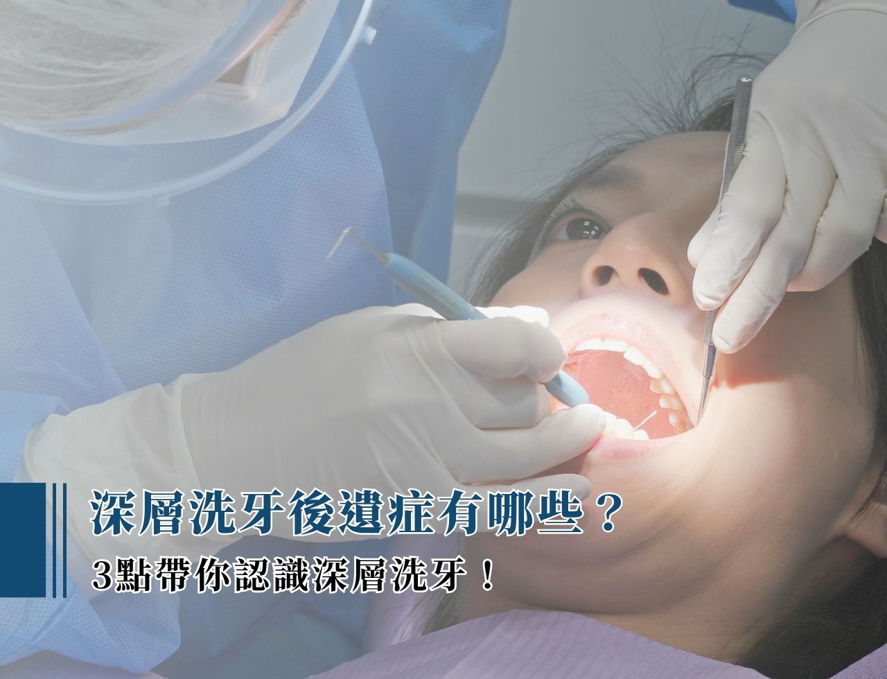 深層洗牙後遺症有哪些?3 點帶你認識深層洗牙