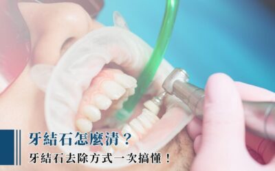牙結石怎麼清？牙結石去除方式一次搞懂！