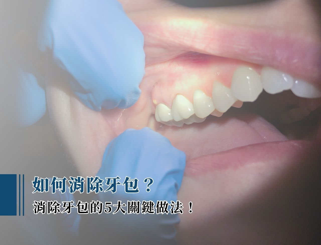 如何消除牙包？消除牙包的 5 大關鍵做法！